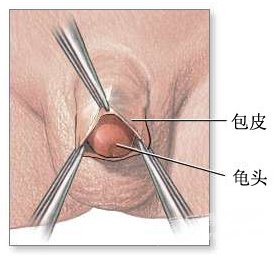 包皮手术后多久可以痊愈-遂宁爱德华医院男科