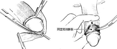 男性阴茎短小的原因有哪些-遂宁爱德华医院男科