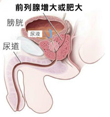 前列腺肥大治疗后复查重要吗