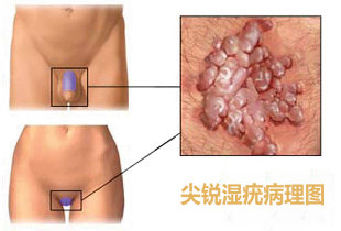 男性尖锐性湿疣症状都有哪些？