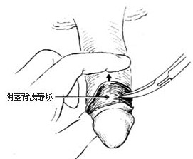 包皮手术