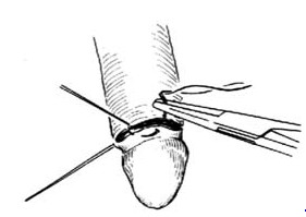 包皮手术