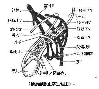 精索静脉曲张